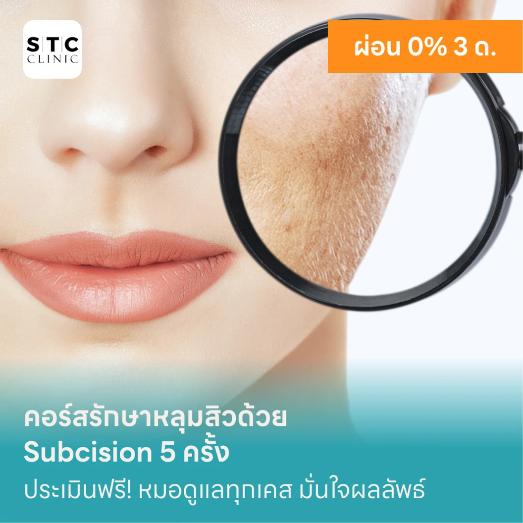 คอร์สรักษาหลุมสิวด้วย Subcision 5 ครั้ง