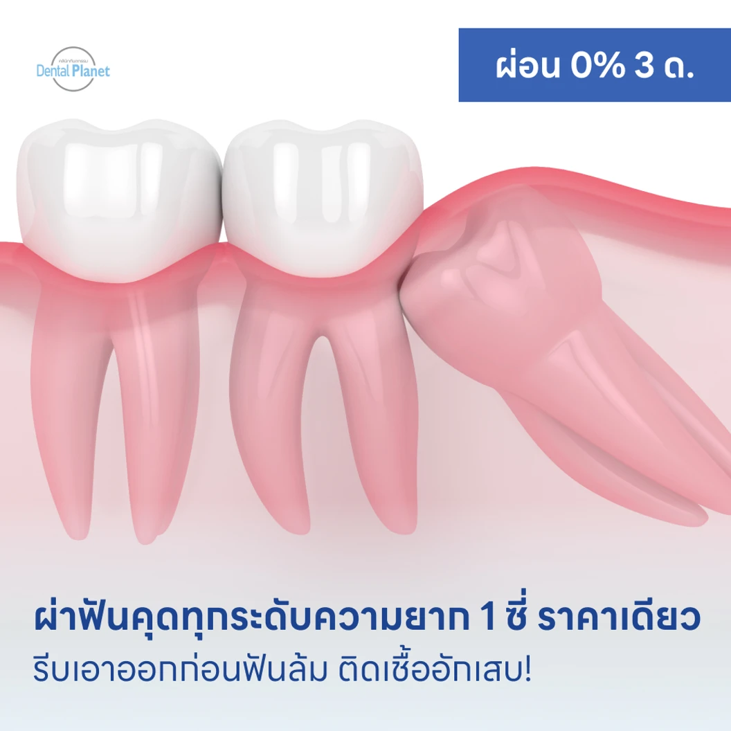 ผ่าฟันคุดทุกระดับความยาก 1 ซี่ ราคาเดียว