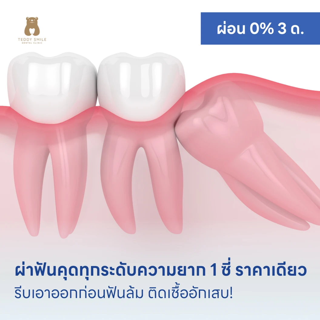 ผ่าฟันคุดทุกระดับความยาก 1 ซี่ ราคาเดียว