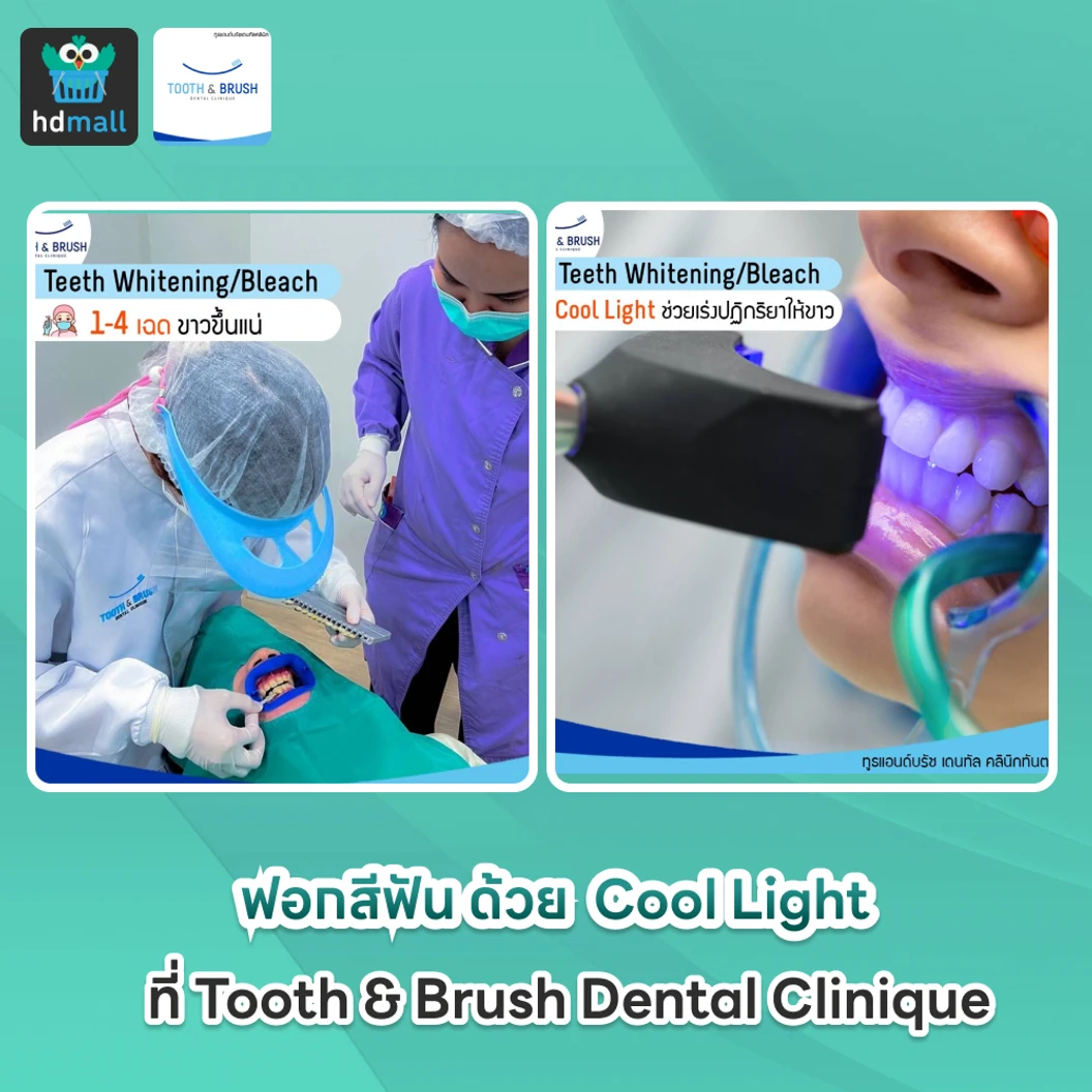 ฟอกสีฟัน ด้วยระบบ Cool Light