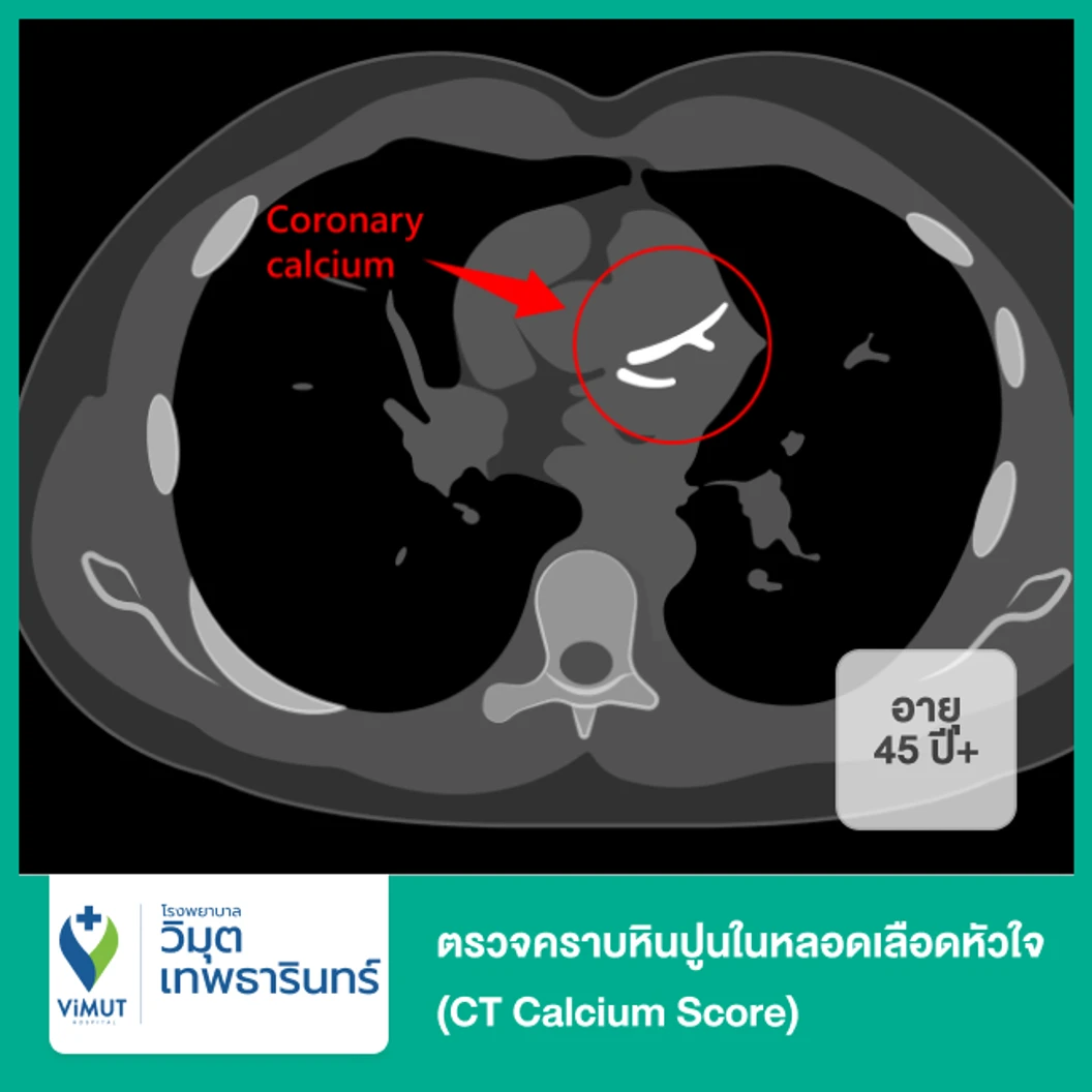 ตรวจคราบหินปูนในหลอดเลือดหัวใจ (CT Calcium Score) (45 ปีขึ้นไป)