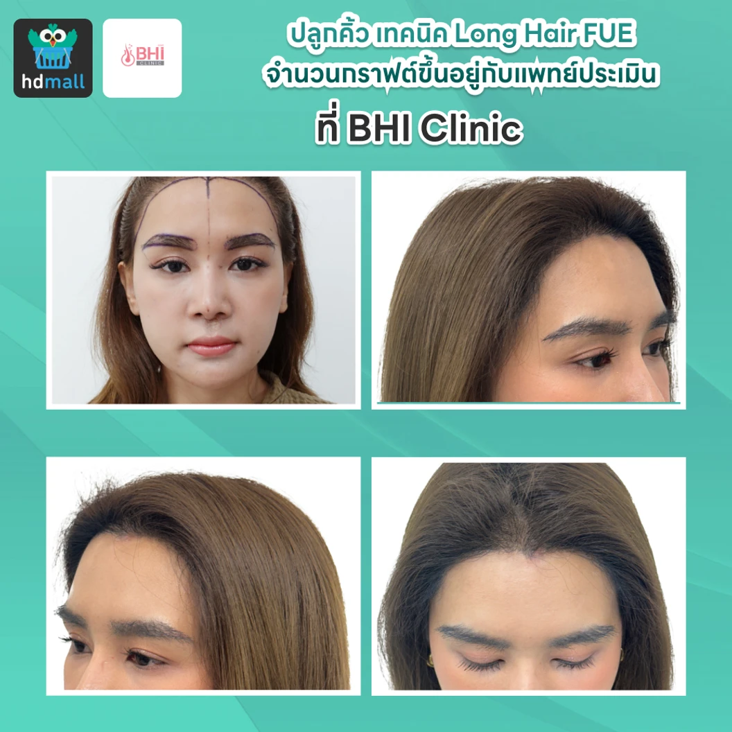 ปลูกคิ้ว เทคนิค Long Hair FUE จำนวนกราฟต์ขึ้นอยู่กับแพทย์ประเมิน