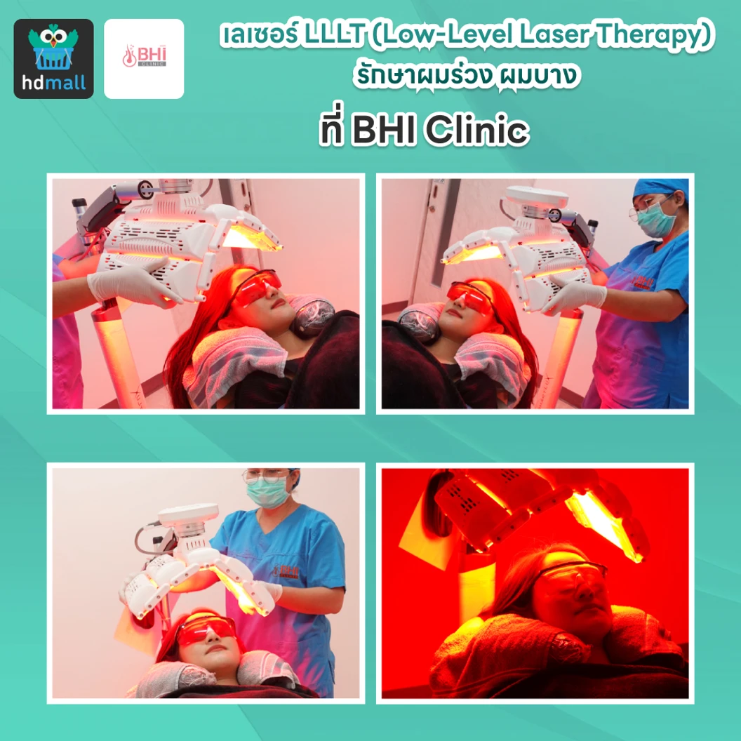 เลเซอร์ LLLT (Low-Level Laser Therapy) รักษาผมร่วง ผมบาง