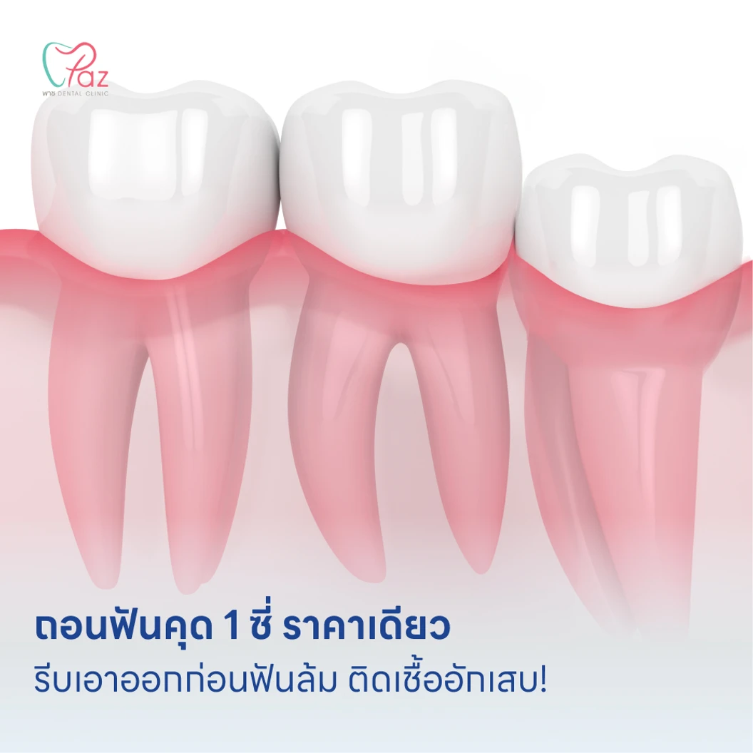 ถอนฟันคุด 1 ซี่ ราคาเดียว