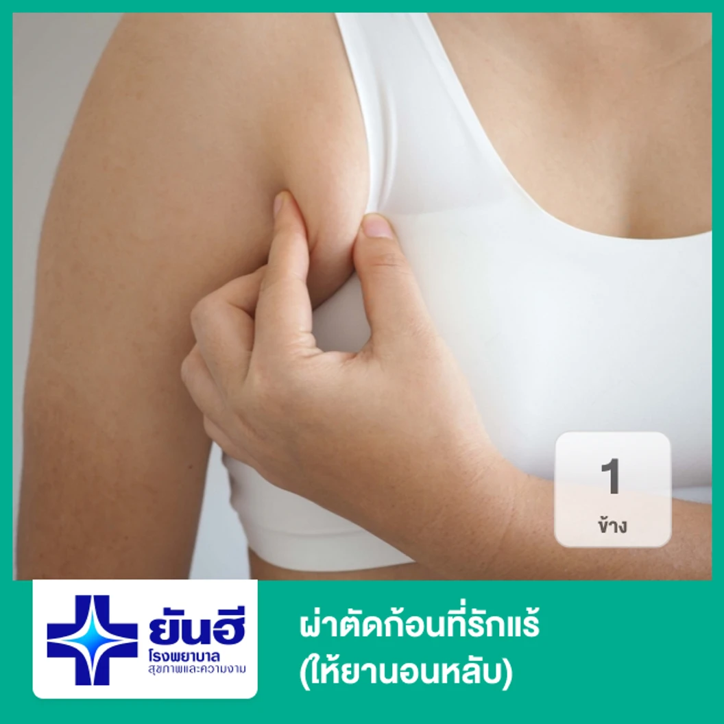 ผ่าตัดก้อนที่รักแร้ 1 ข้าง (ให้ยานอนหลับ)
