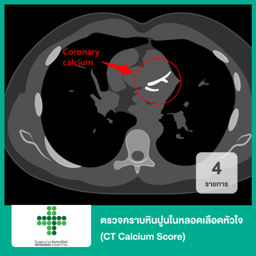 ตรวจคราบหินปูนในหลอดเลือดหัวใจ 4 รายการ (CT Calcium Score)