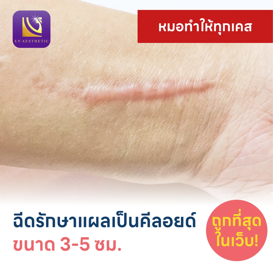 ฉีดรักษาแผลเป็นคีลอยด์ ขนาดเส้นผ่านศูนย์กลาง 3-5 ซม. 1 จุด 1 ครั้ง