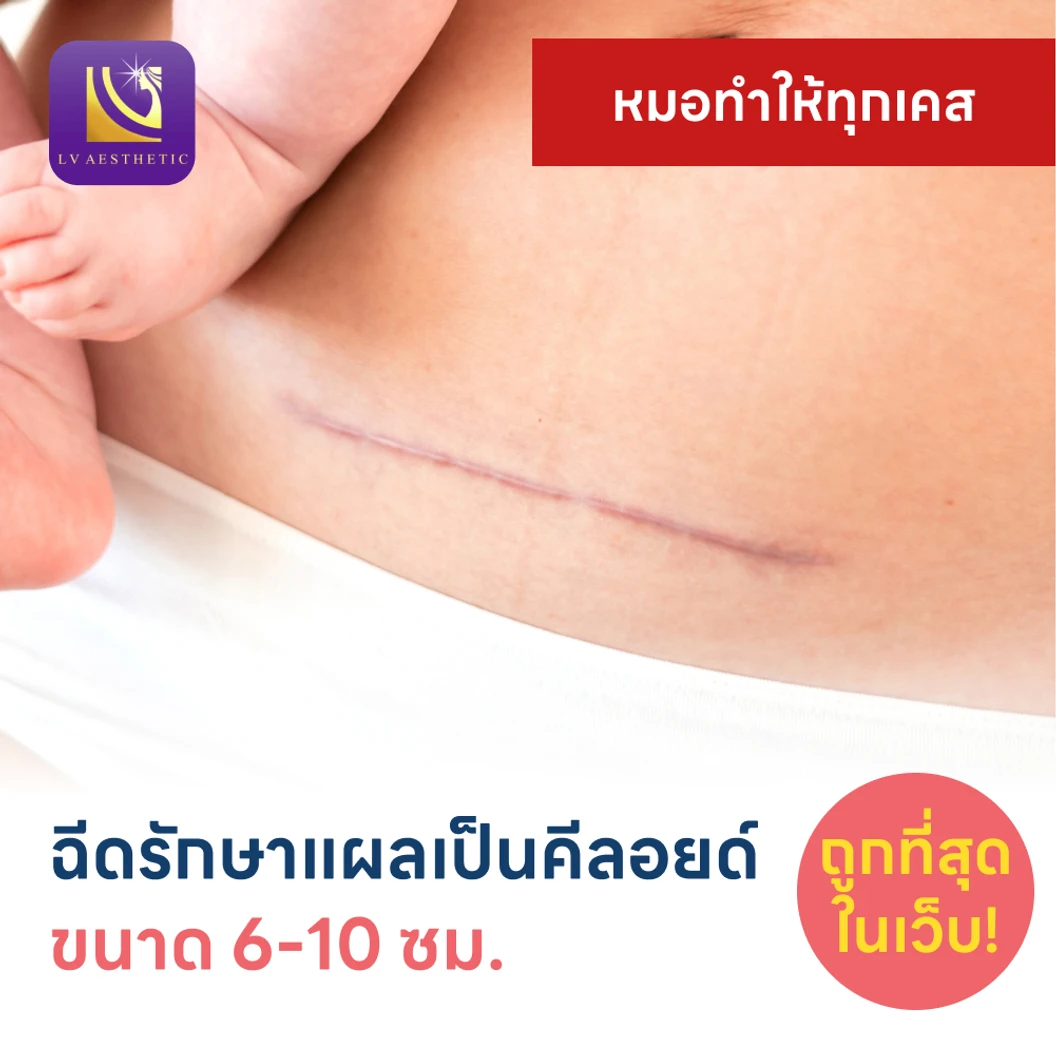 ฉีดรักษาแผลเป็นคีลอยด์ ขนาดเส้นผ่านศูนย์กลาง 6-10 ซม. 1 จุด 1 ครั้ง