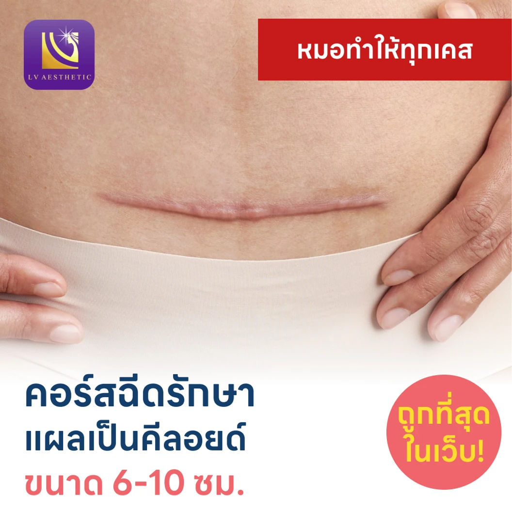 คอร์สฉีดรักษาแผลเป็นคีลอยด์ ขนาดเส้นผ่านศูนย์กลาง 6-10 ซม. 1 จุด 5 ครั้ง