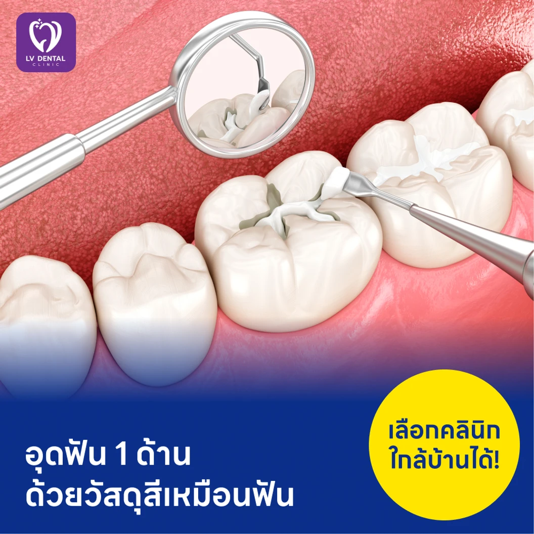 อุดฟัน 1 ด้าน ด้วยวัสดุสีเหมือนฟัน