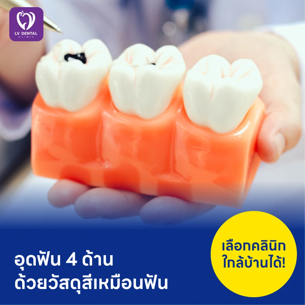 อุดฟัน 4 ด้าน ด้วยวัสดุสีเหมือนฟัน