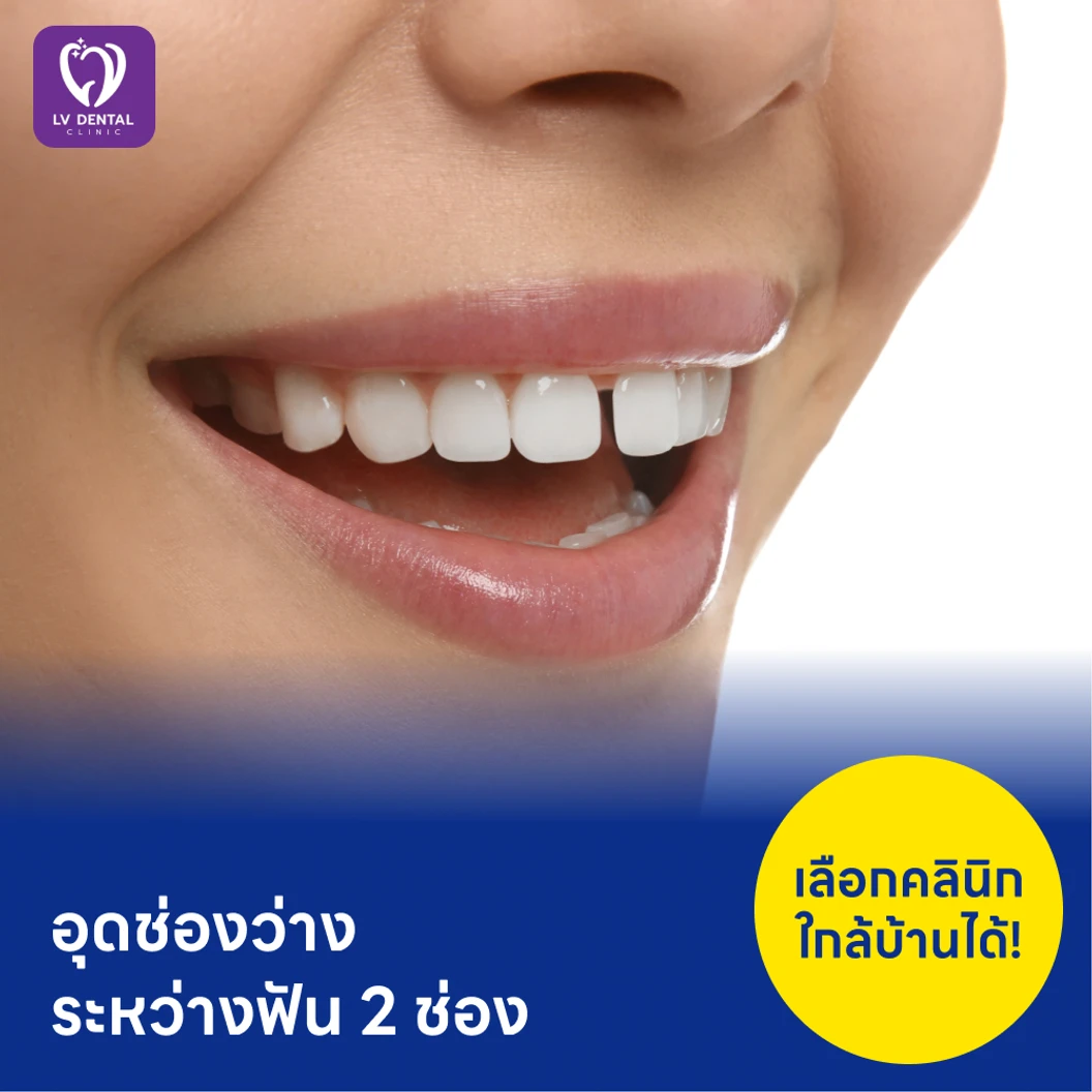 อุดช่องว่างระหว่างฟัน 2 ช่อง