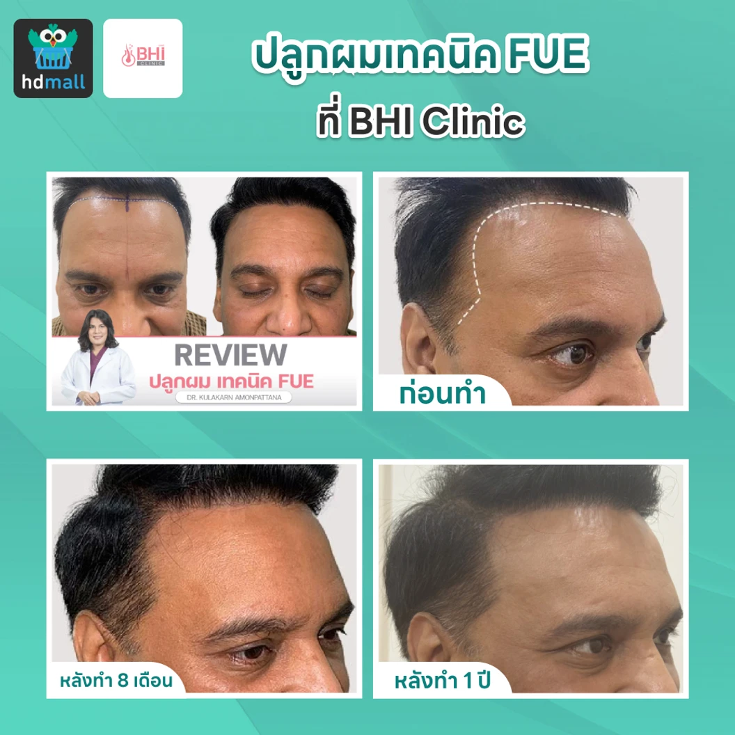 ปลูกผมเทคนิค FUE จำนวนกราฟต์ขึ้นอยู่กับแพทย์ประเมิน