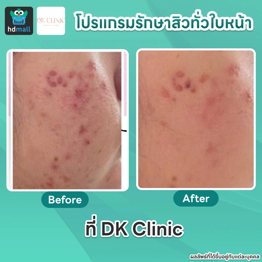 คอร์สโปรแกรมรักษาสิวทั่วใบหน้า 4 ขั้นตอน 4 ครั้ง ฟรี! 1 ครั้ง