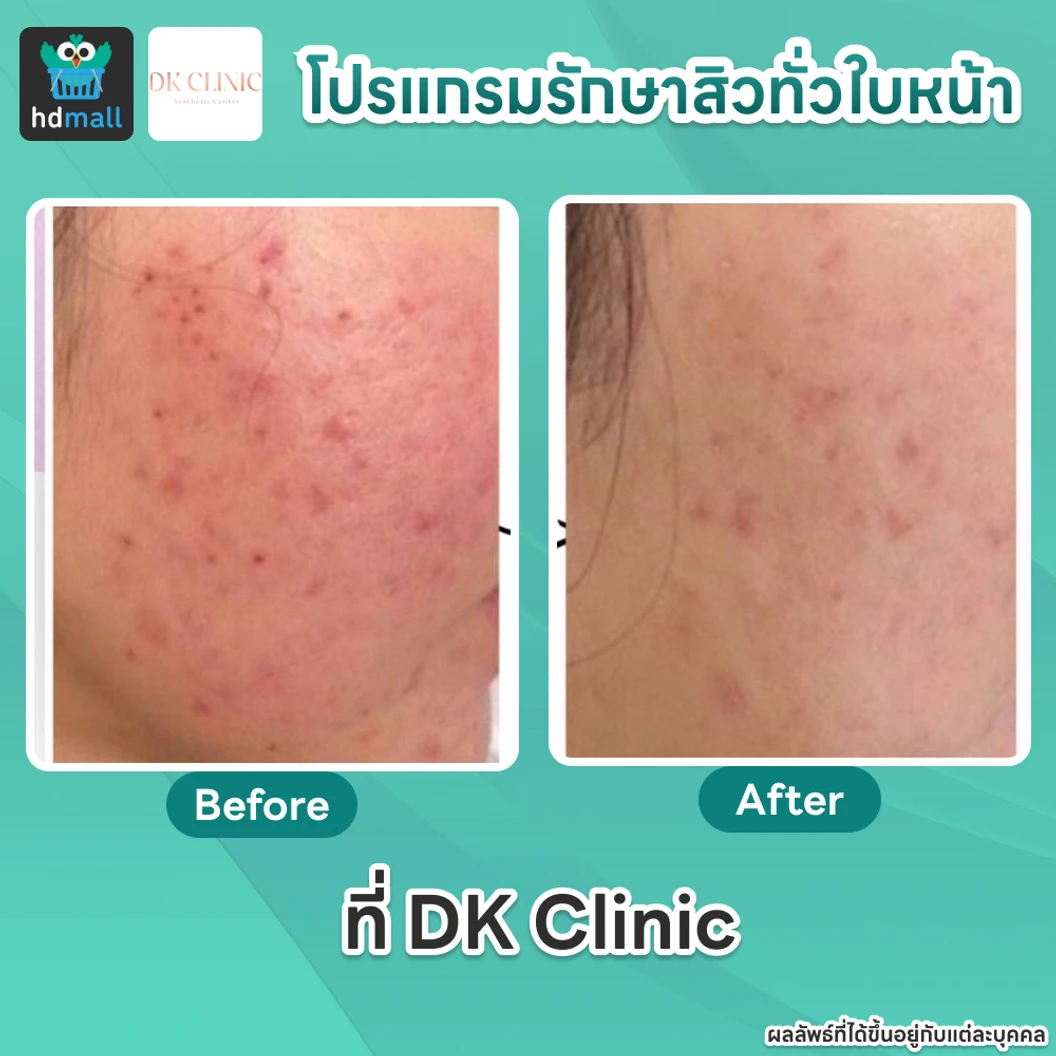 คอร์สโปรแกรมรักษาสิวทั่วใบหน้า 4 ขั้นตอน 4 ครั้ง ฟรี! 1 ครั้ง