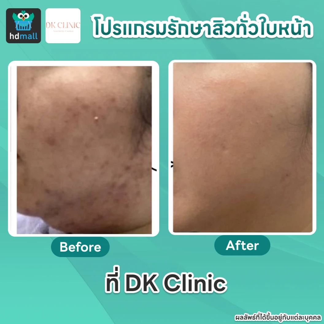 คอร์สโปรแกรมรักษาสิวทั่วใบหน้า 4 ขั้นตอน 4 ครั้ง ฟรี! 1 ครั้ง