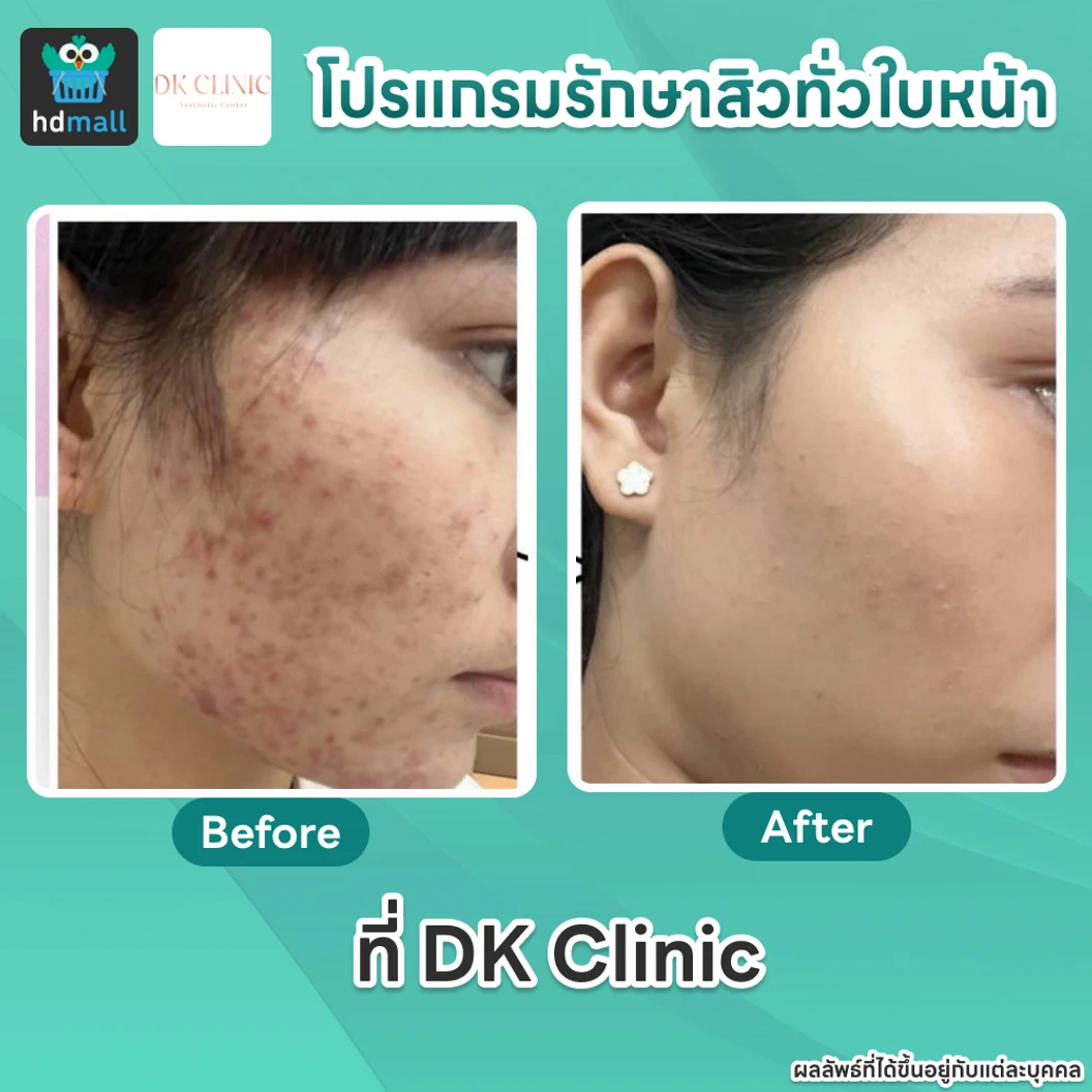 คอร์สโปรแกรมรักษาสิวทั่วใบหน้า 4 ขั้นตอน 4 ครั้ง ฟรี! 1 ครั้ง