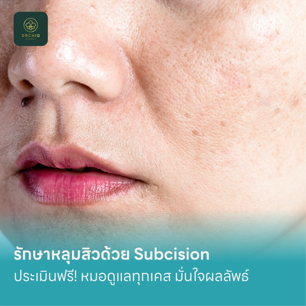 รักษาหลุมสิวด้วย Subcision