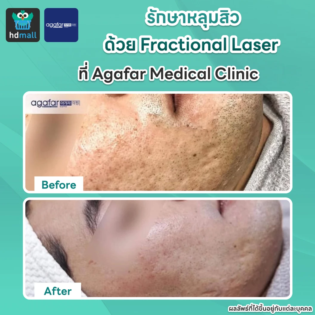 คอร์สรักษาหลุมสิวด้วย Fractional Laser 3 ครั้ง