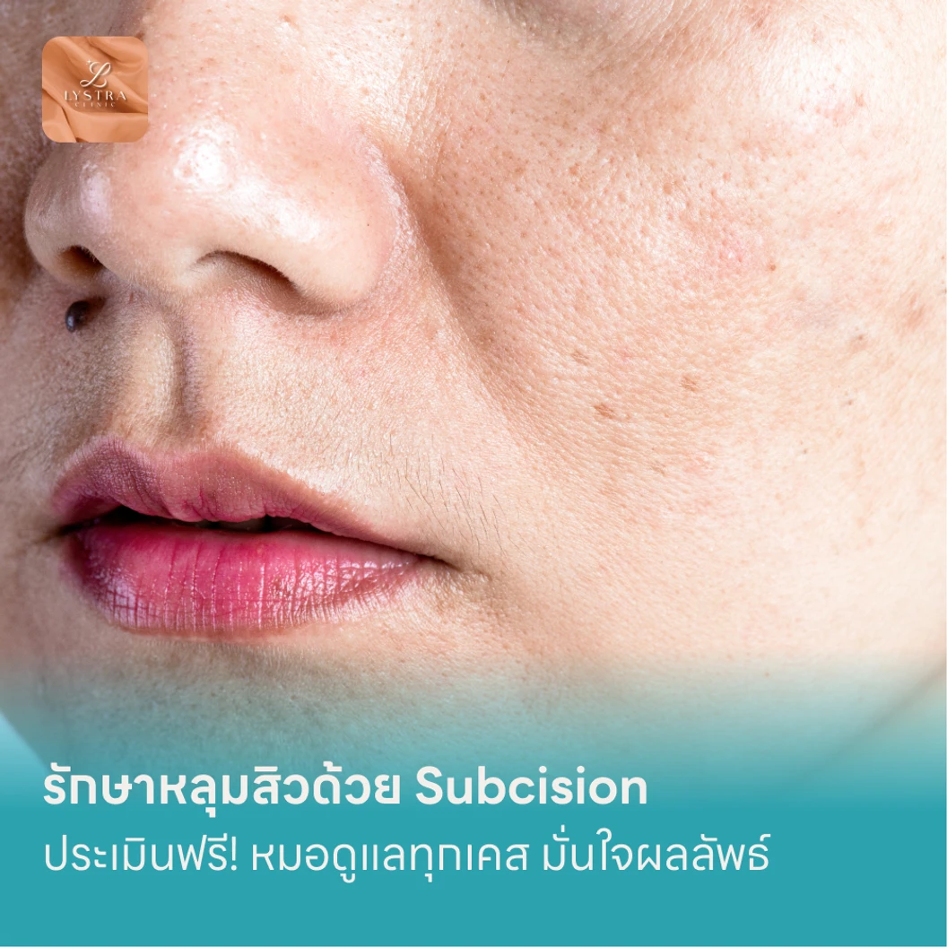 รักษาหลุมสิวด้วย Subcision