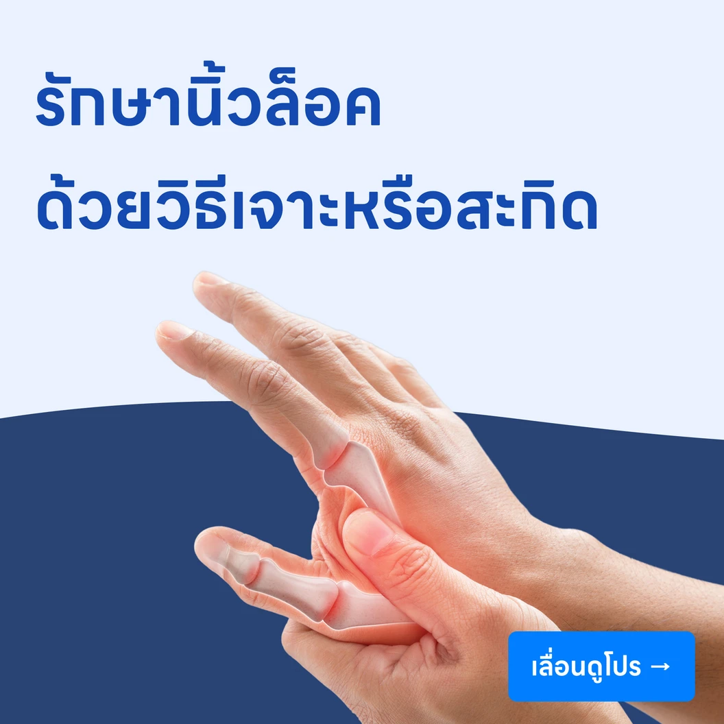 รักษานิ้วล็อค ด้วยวิธีเจาะหรือสะกิด