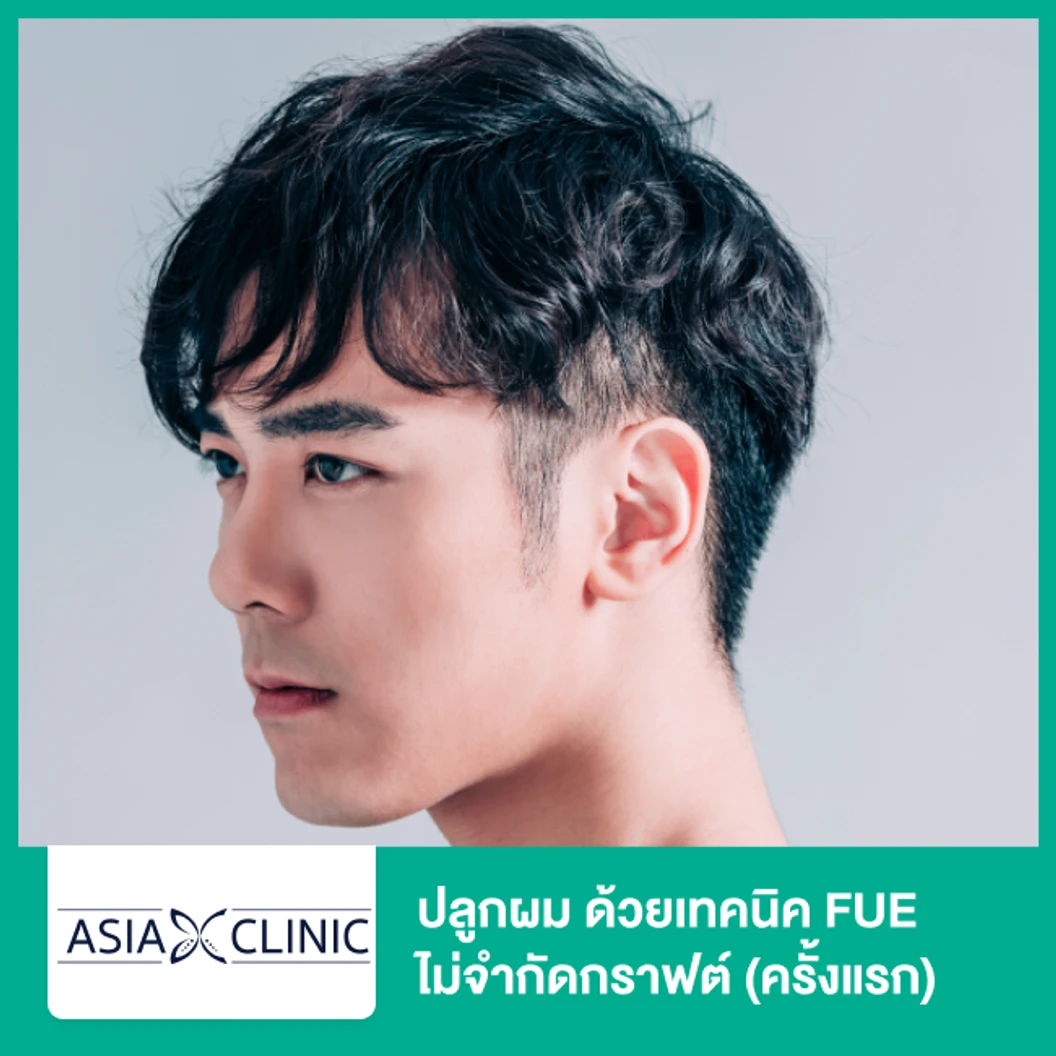 ปลูกผม ด้วยเทคนิค FUE ไม่จำกัดกราฟต์ (ครั้งแรก)
