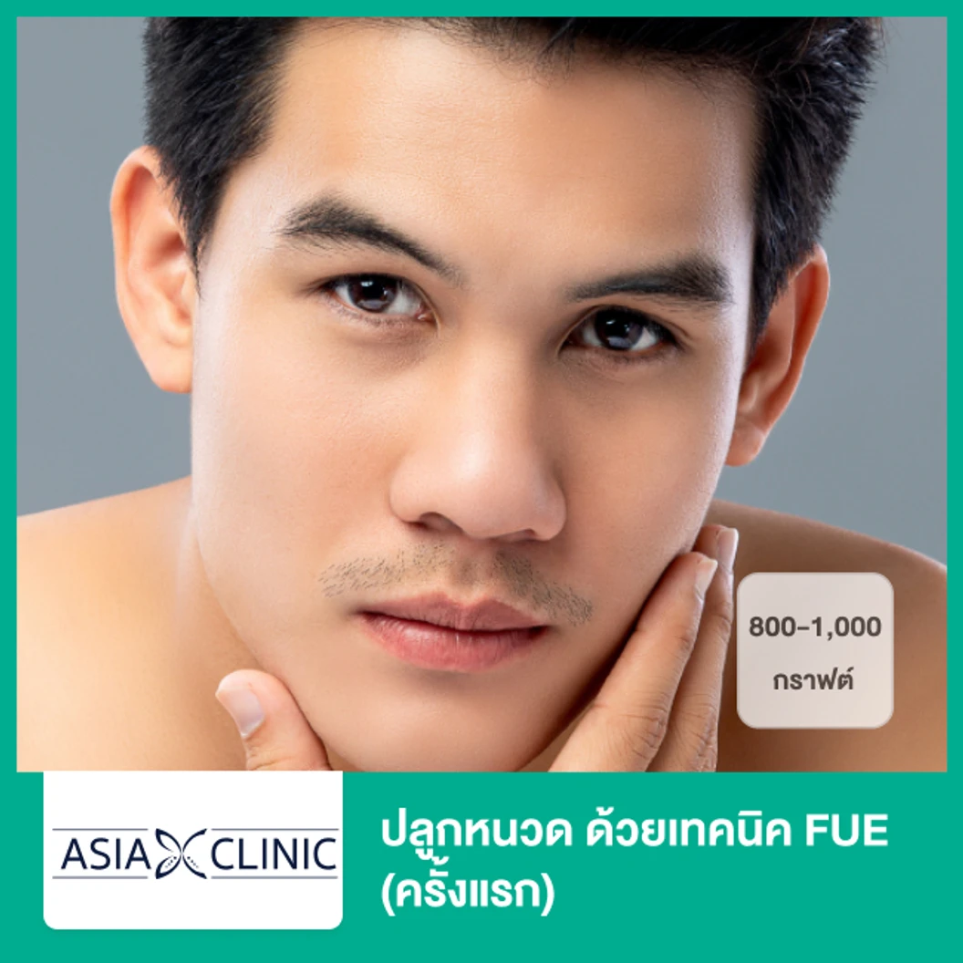 ปลูกหนวด ด้วยเทคนิค FUE 800-1,000 กราฟต์ (ครั้งแรก)