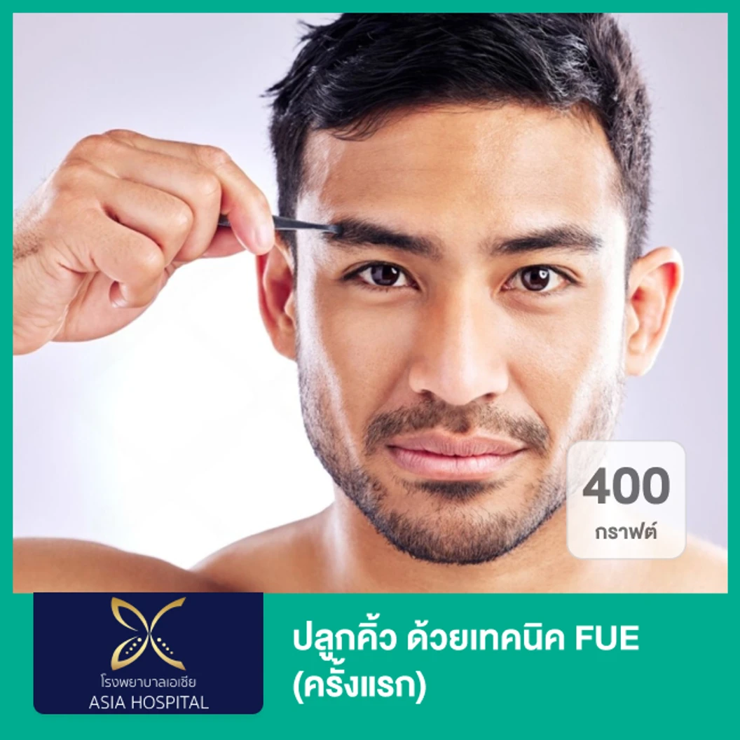 ปลูกคิ้ว ด้วยเทคนิค FUE 400 กราฟต์ (ครั้งแรก)