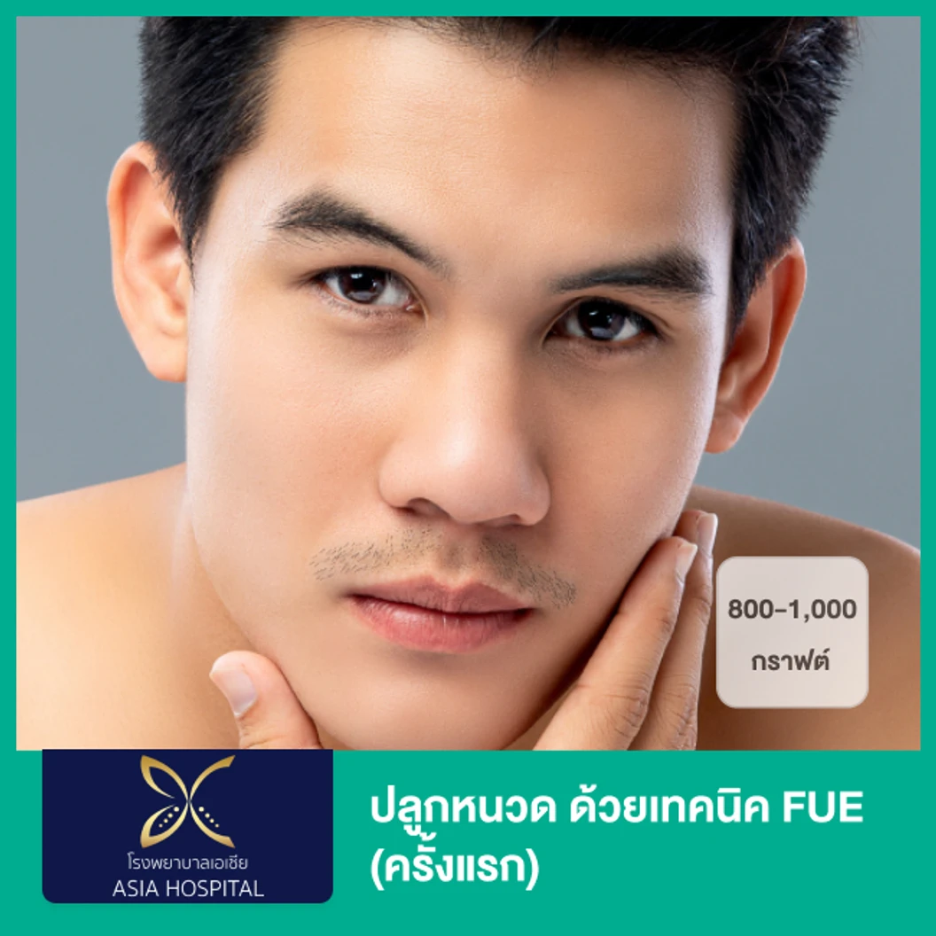 ปลูกหนวด ด้วยเทคนิค FUE 800-1,000 กราฟต์ (ครั้งแรก)