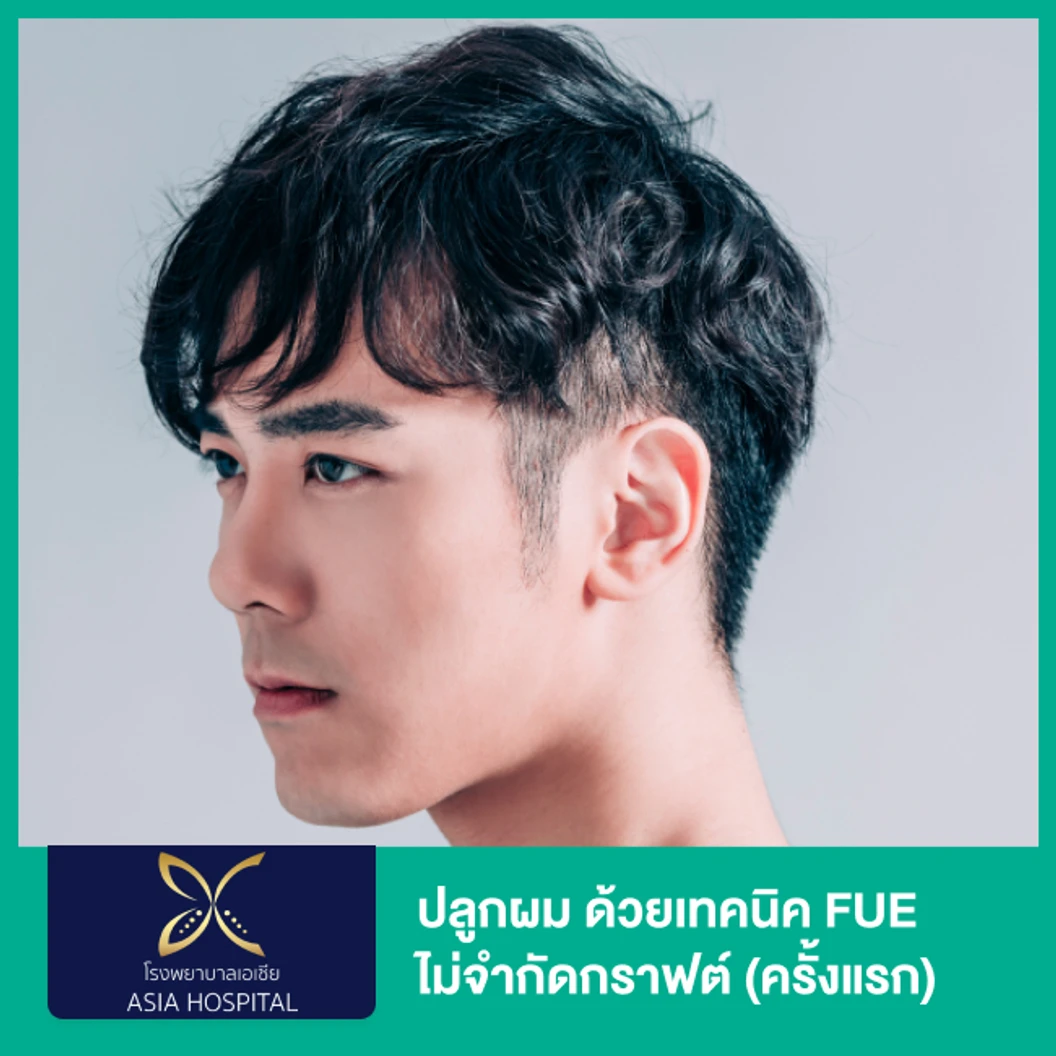 ปลูกผม ด้วยเทคนิค FUE ไม่จำกัดกราฟต์ (ครั้งแรก)