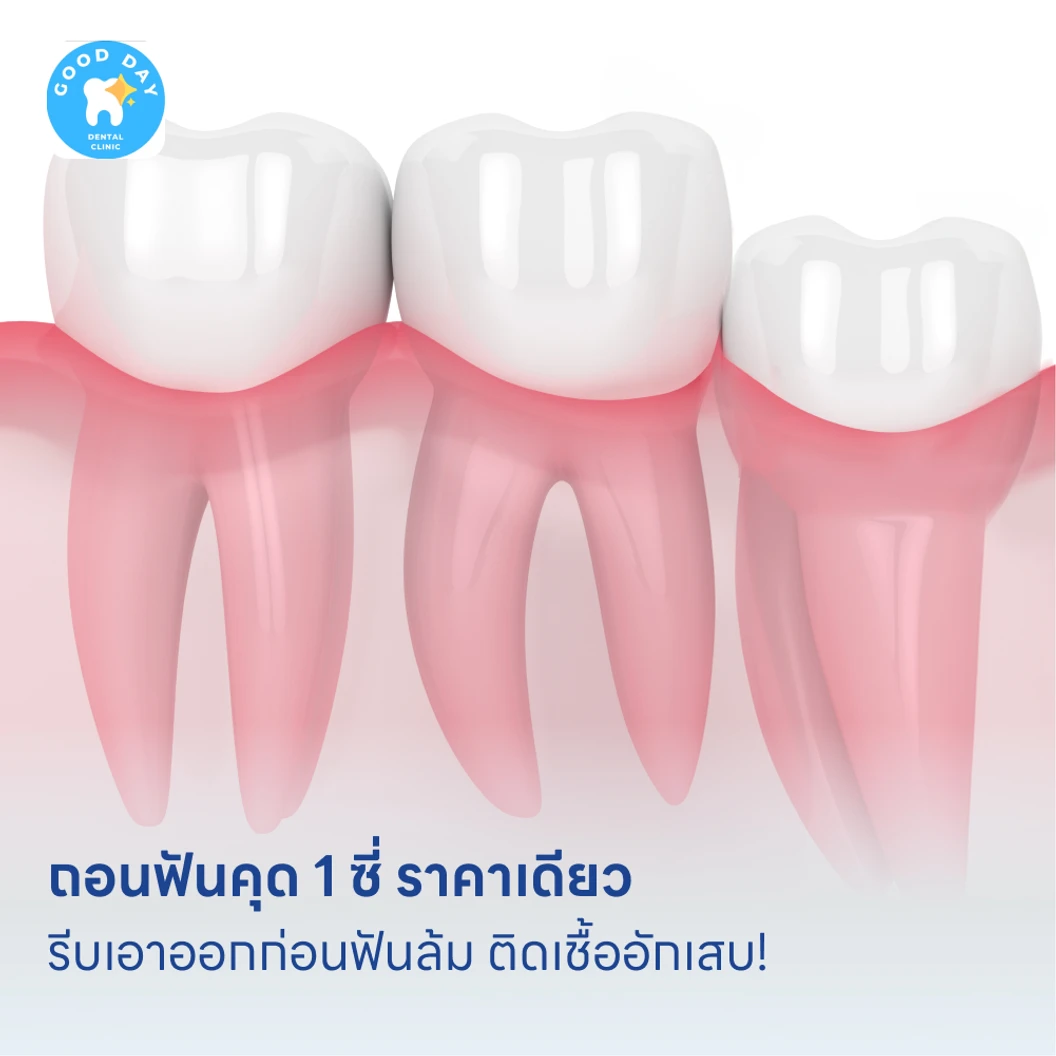 ถอนฟันคุด 1 ซี่ ราคาเดียว