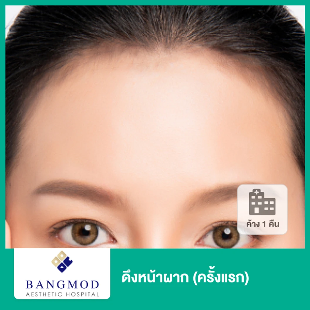 ดึงหน้าผาก ด้วยเทคนิคพิเศษ Modern Facelift Plus เฉพาะที่ รพ. บางมด นอนพักที่ รพ. 2 วัน 1 คืน (ครั้งแรก)