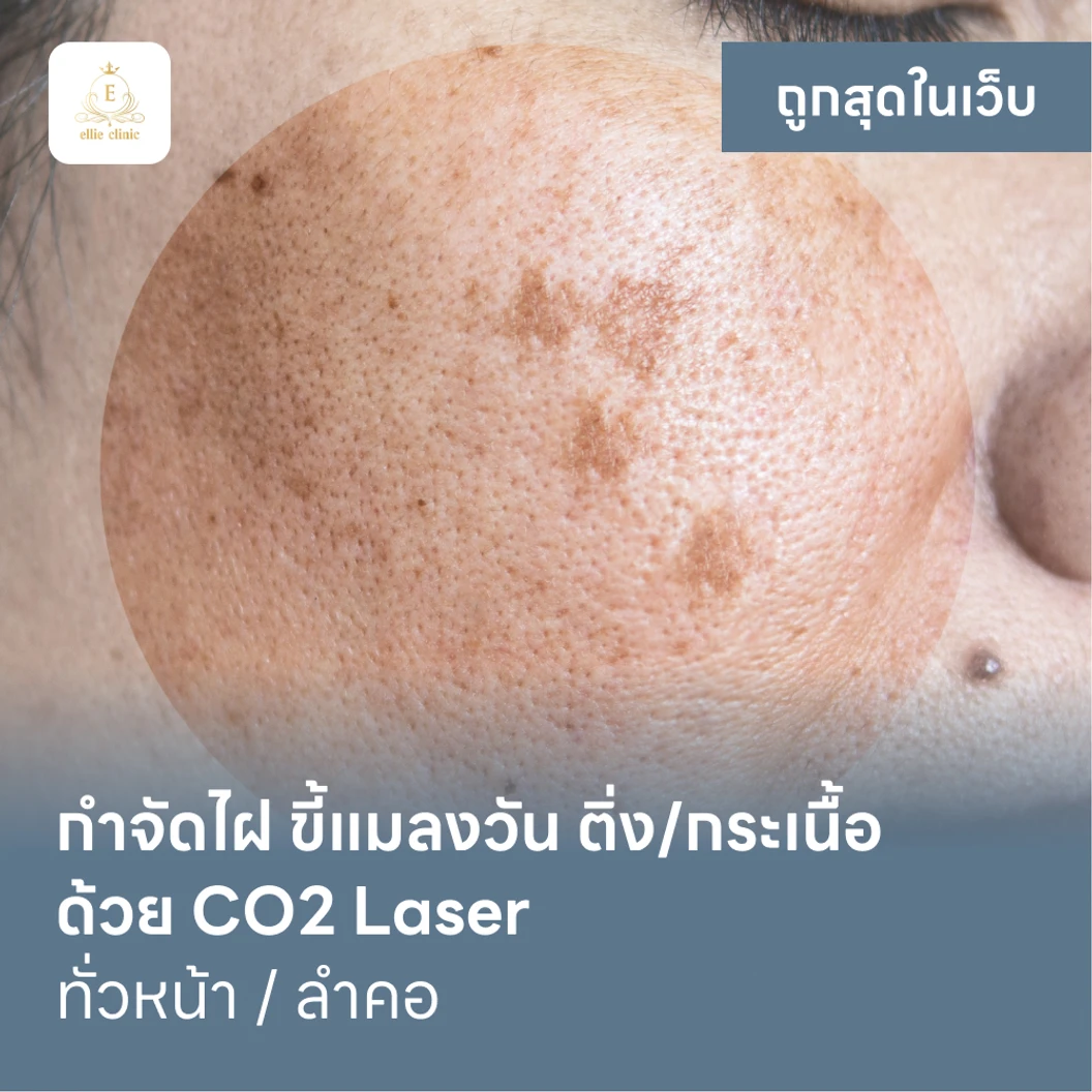 กำจัดไฝ ขี้แมลงวัน ติ่งเนื้อ กระเนื้อ ด้วย CO2 Laser ขนาดเส้นผ่านศูนย์กลางไม่เกิน 2 มม. ไม่จำกัดจุดทั่วใบหน้าหรือลำคอ 1 ครั้ง