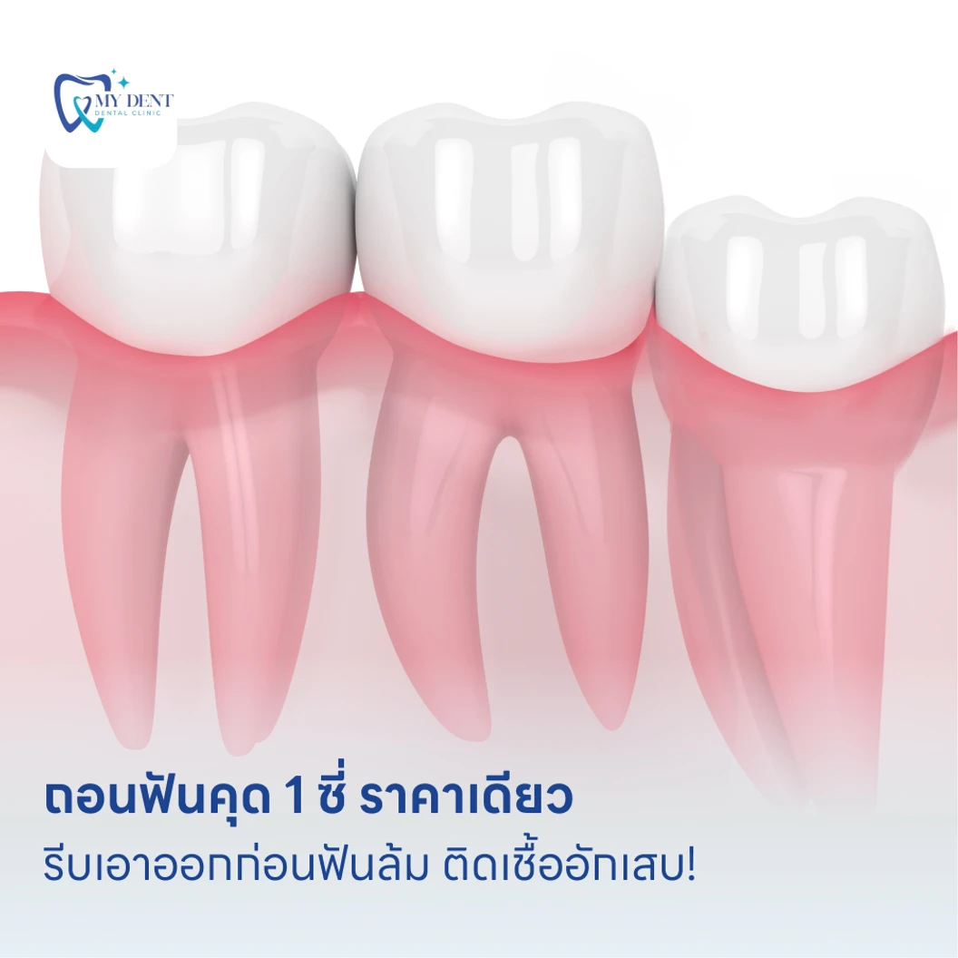 ถอนฟันคุด 1 ซี่ ราคาเดียว