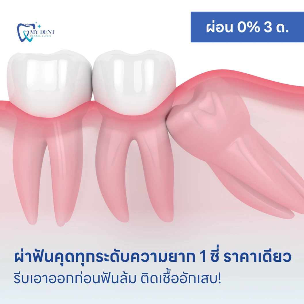 ผ่าฟันคุดทุกระดับความยาก 1 ซี่ ราคาเดียว