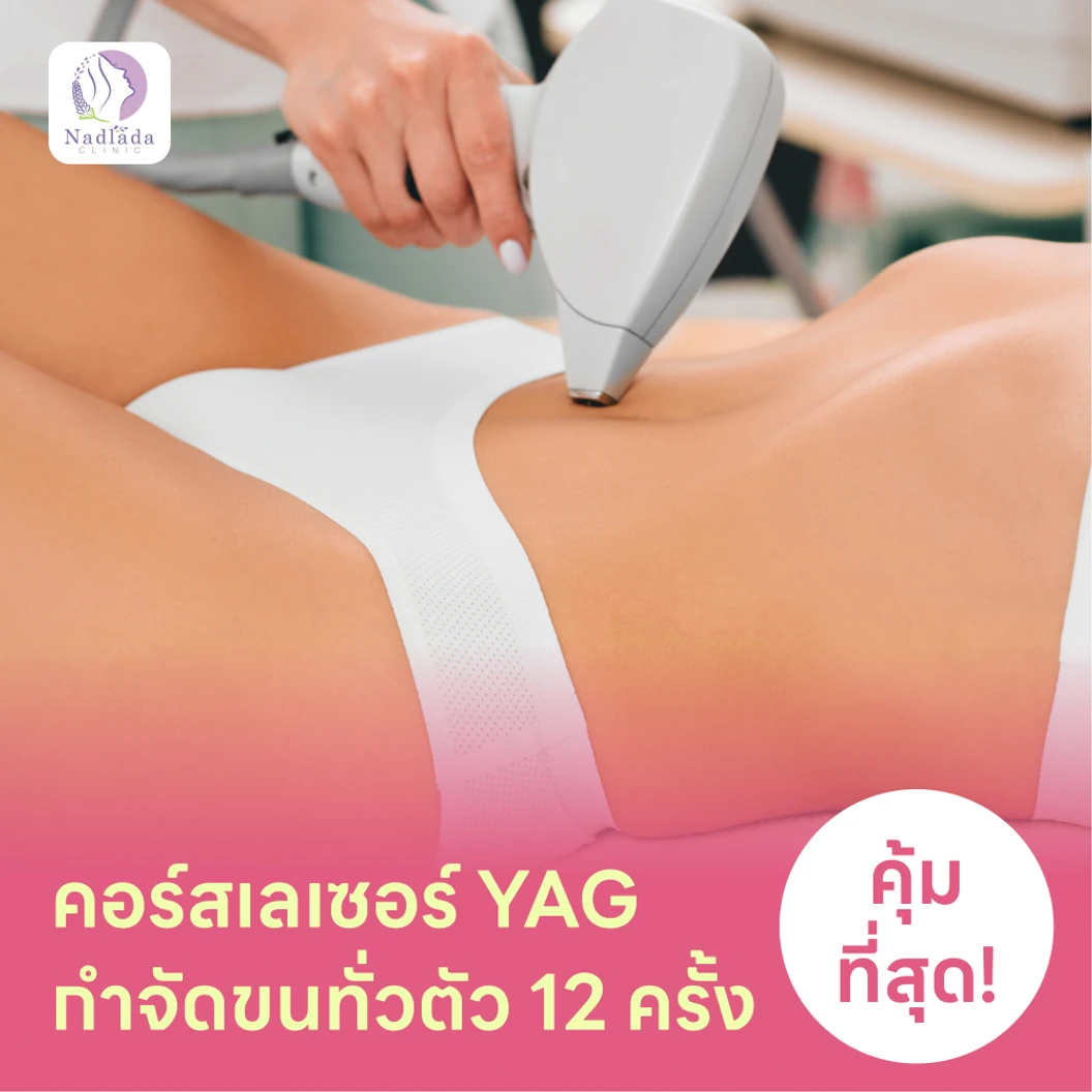 คอร์สเลเซอร์กำจัดขนเหมาทั่วตัว 12 ครั้ง ด้วย YAG Laser (ผู้หญิงเท่านั้น)