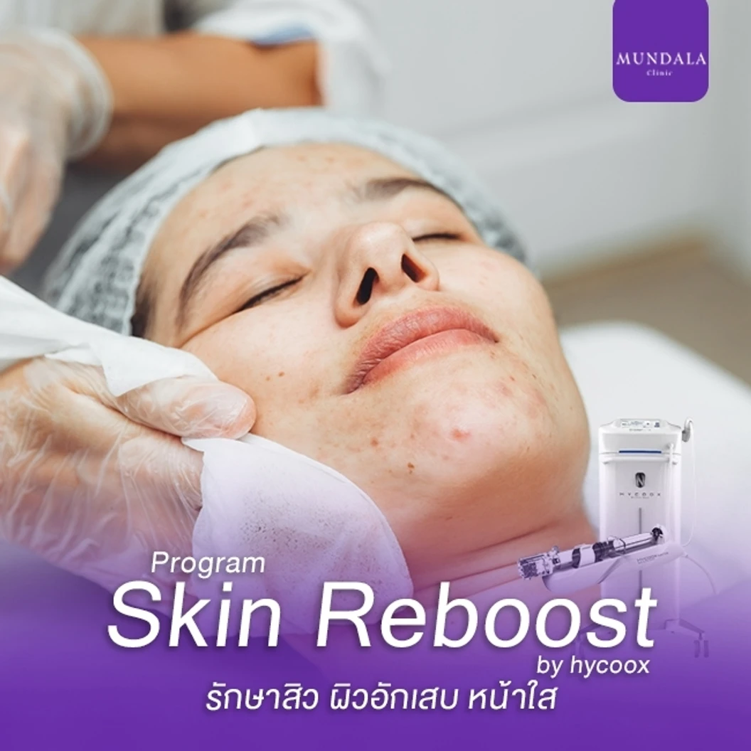 โปรแกรมเมโสหน้า Skin Reboost รักษาสิว ผิวอักเสบ 3 ซีซี