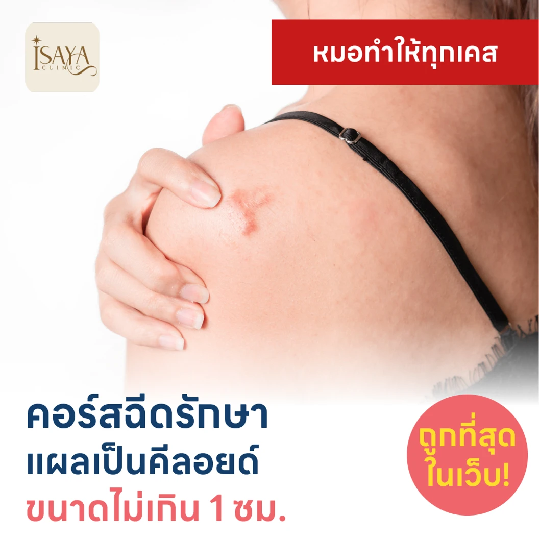 คอร์สฉีดรักษาแผลเป็นคีลอยด์ ขนาดเส้นผ่านศูนย์กลางไม่เกิน 1 ซม. 1 จุด 5 ครั้ง
