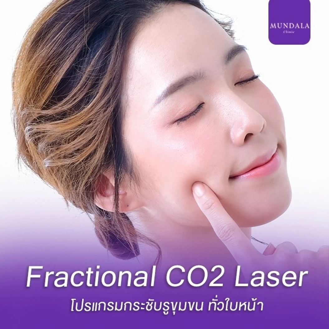 เลเซอร์ Fractional CO2 กระชับรูขุมขนหน้า