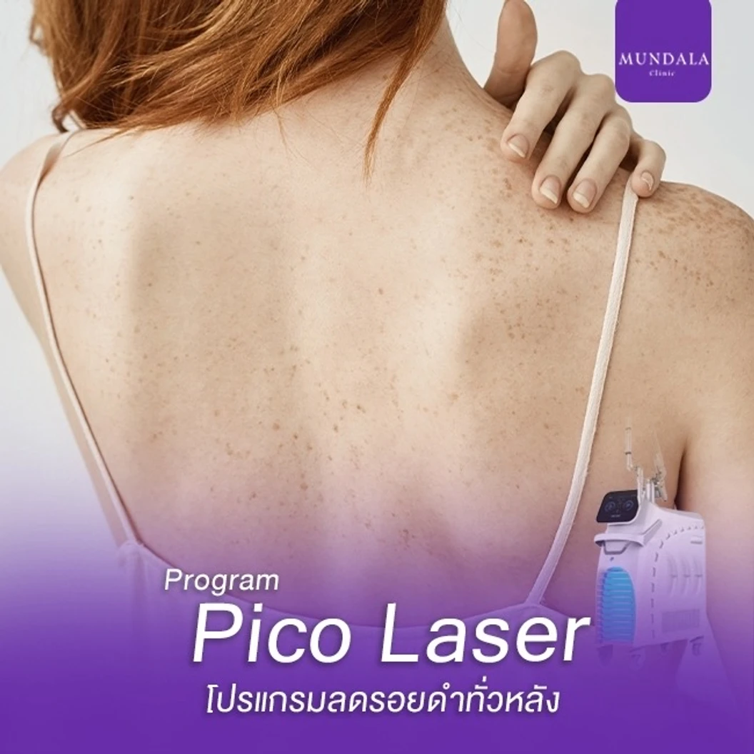 เลเซอร์ Pico หลัง ลดรอยดำคล้ำ (จำนวนช็อตขึ้นอยู่กับแพทย์ประเมิน)