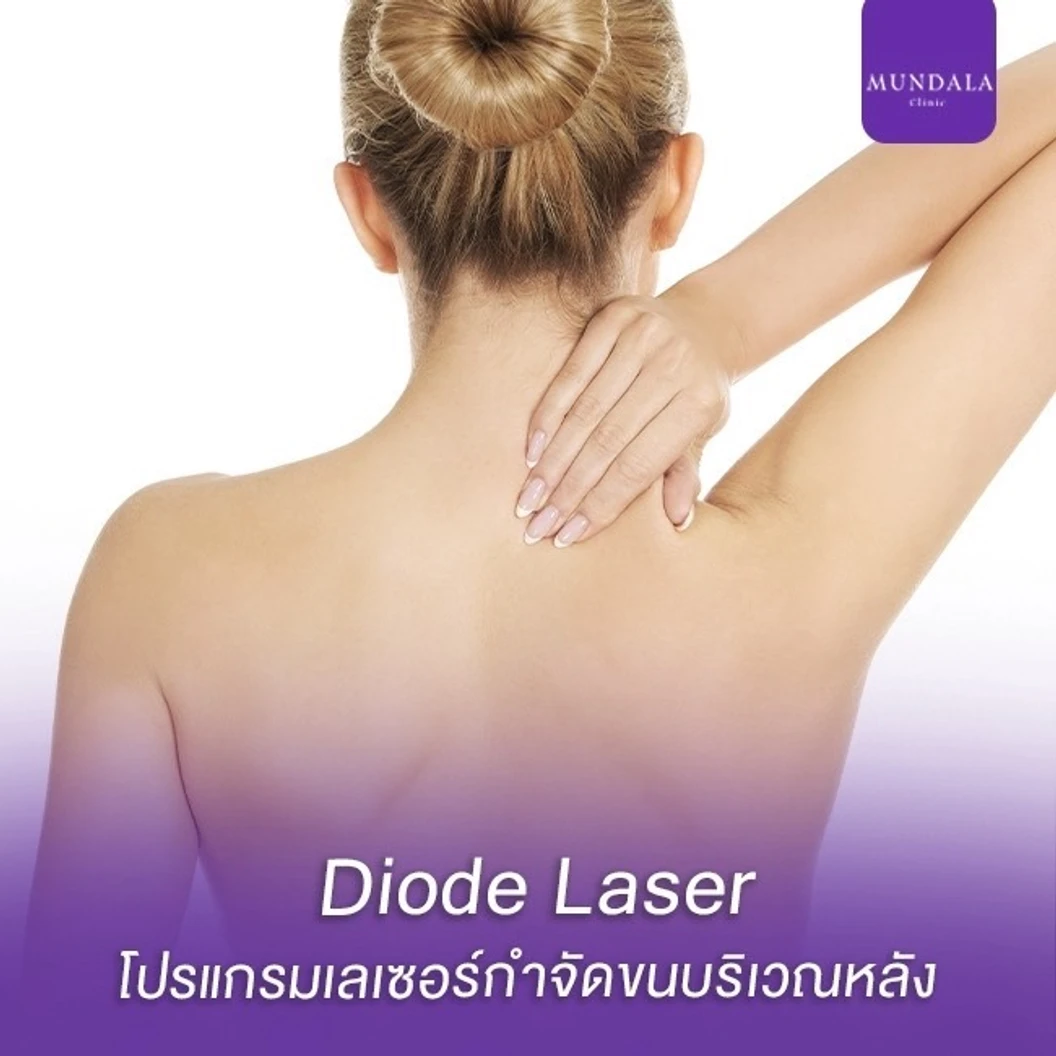 เลเซอร์ Diode กำจัดขนหลัง 1 ครั้ง
