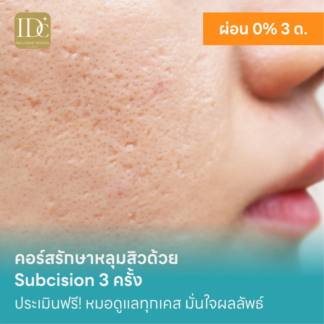 คอร์สรักษาหลุมสิวด้วย Subcision 3 ครั้ง