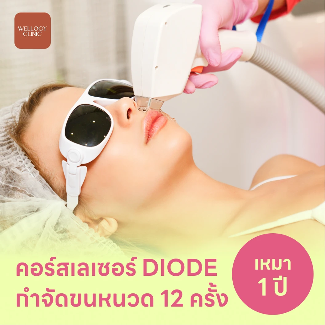 คอร์สเลเซอร์กำจัดขนหนวด 12 ครั้ง ด้วย Diode Laser