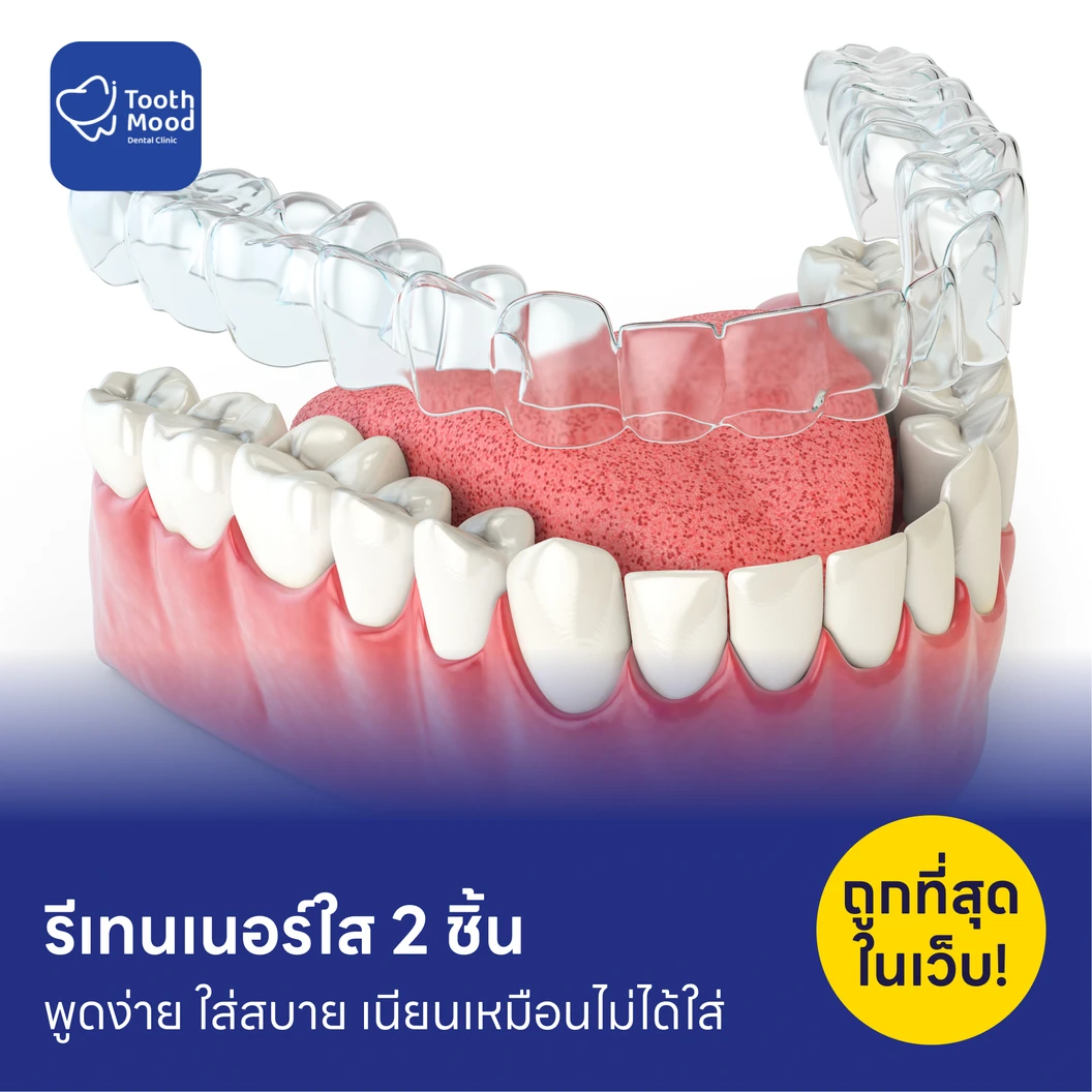 ทำรีเทนเนอร์แบบใส 2 ชิ้น
