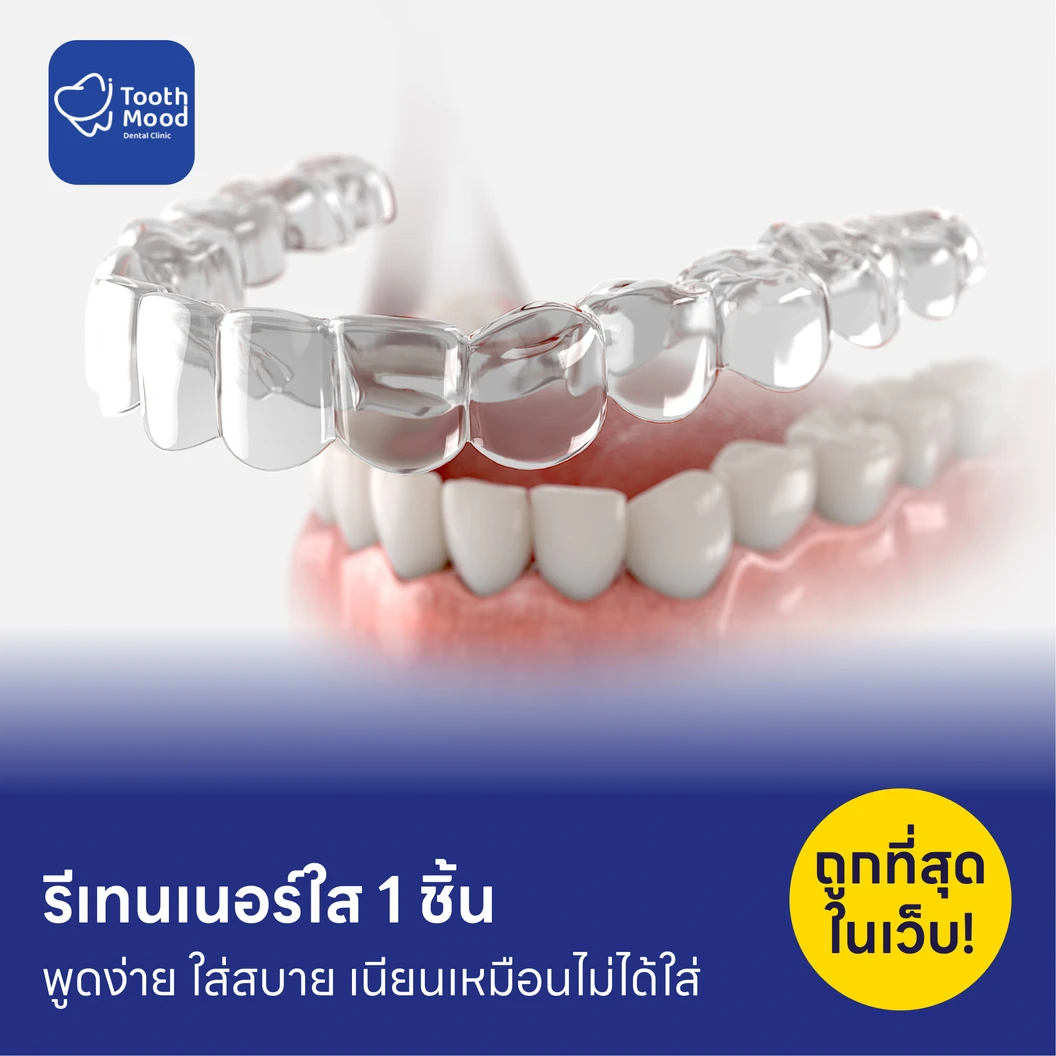 ทำรีเทนเนอร์แบบใส 1 ชิ้น