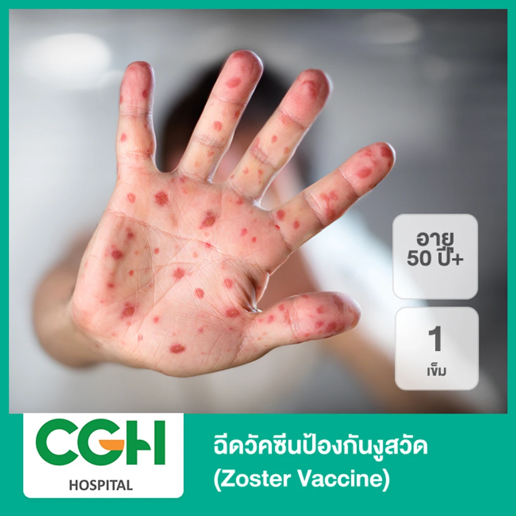 ฉีดวัคซีนป้องกันงูสวัด (Zoster Vaccine) 1 เข็ม (50 ปีขึ้นไป)