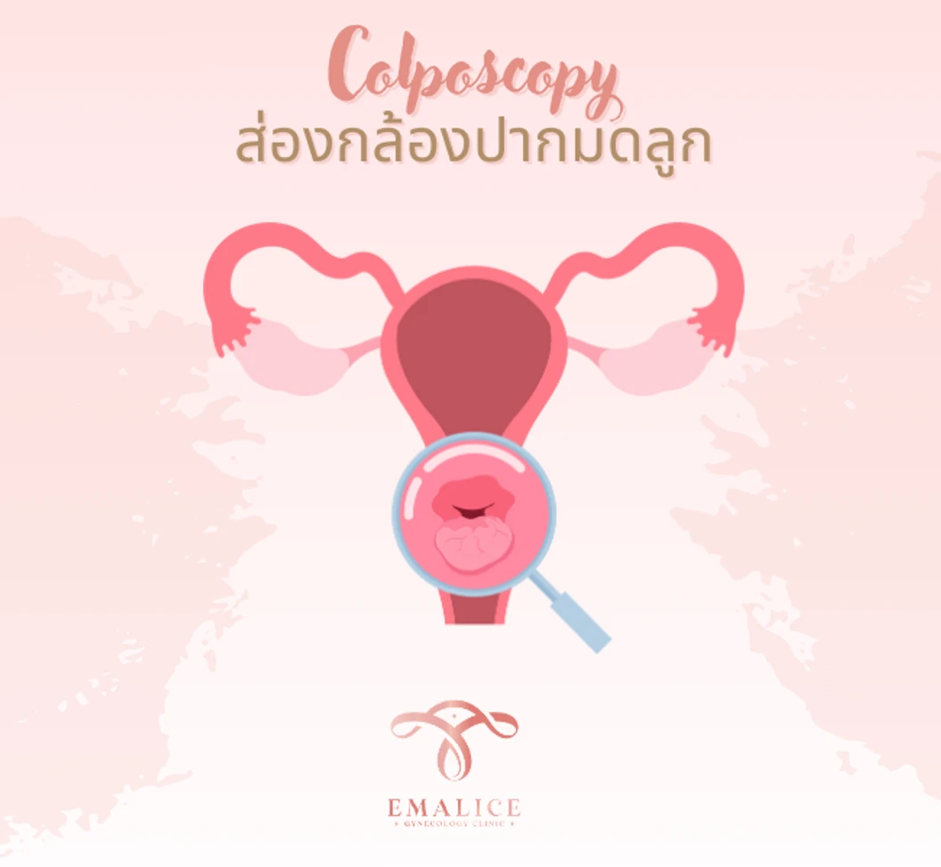 ส่องกล้องตรวจปากมดลูก