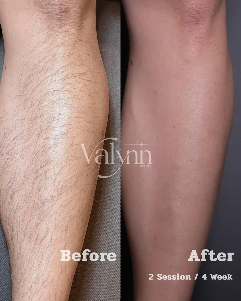 เลเซอร์ Diode กำจัดขน 1 ครั้ง (เลือก 1 จุด รักแร้/หนวด/หลังมือ/หลังเท้า)