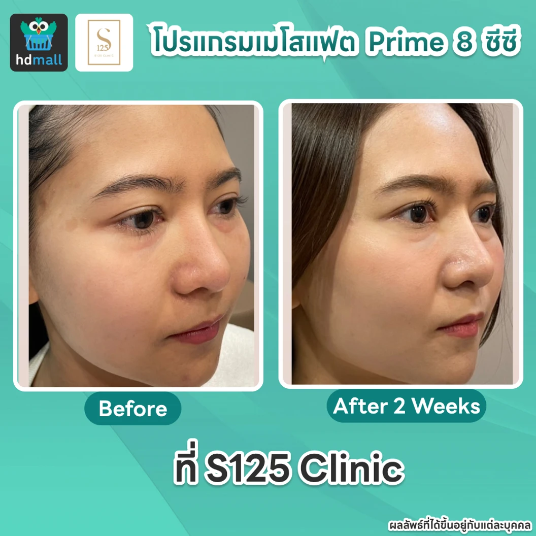 โปรแกรมเมโสแฟตหน้า Prime 8 ซีซี