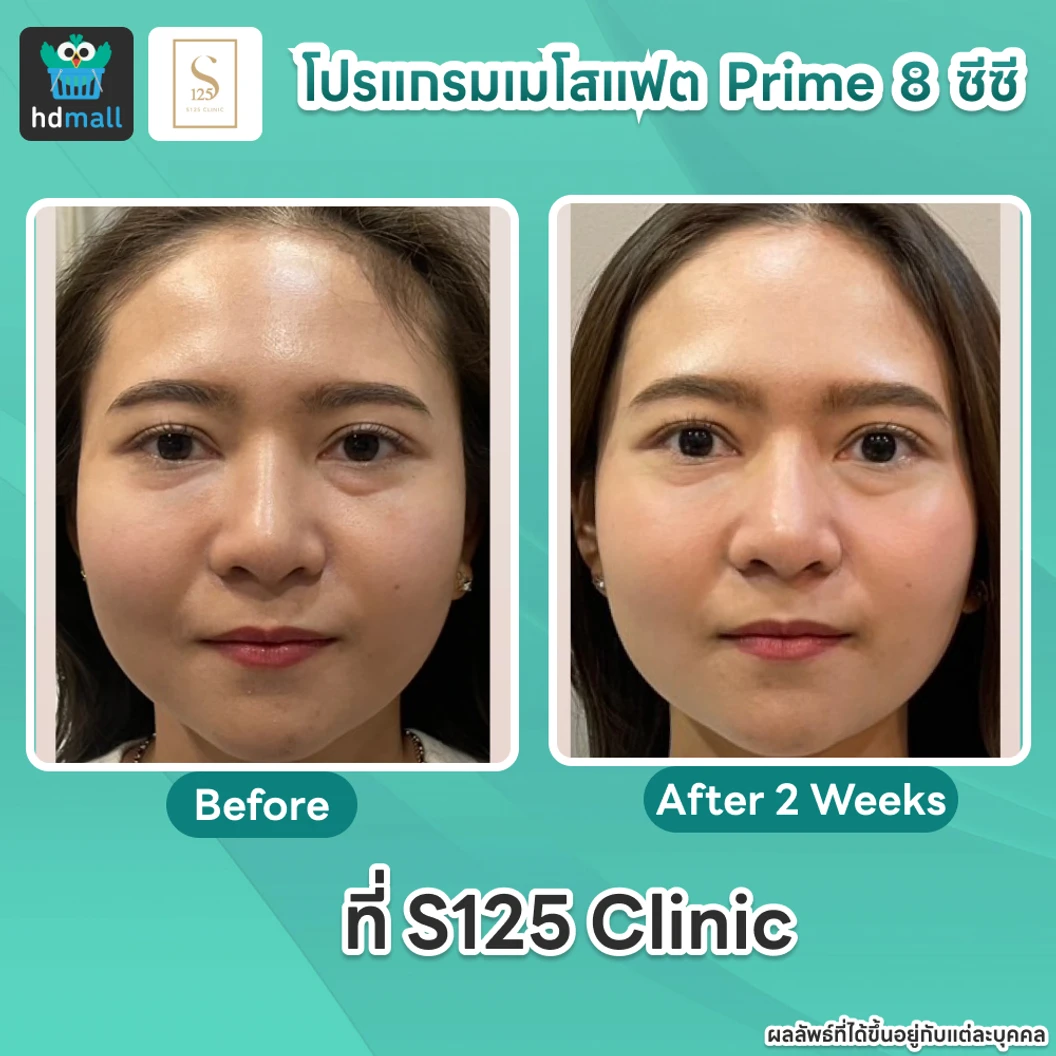 โปรแกรมเมโสแฟตหน้า Prime 8 ซีซี